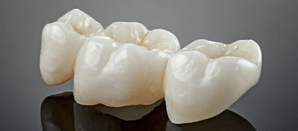 Dental-Crowns-and-Bridges