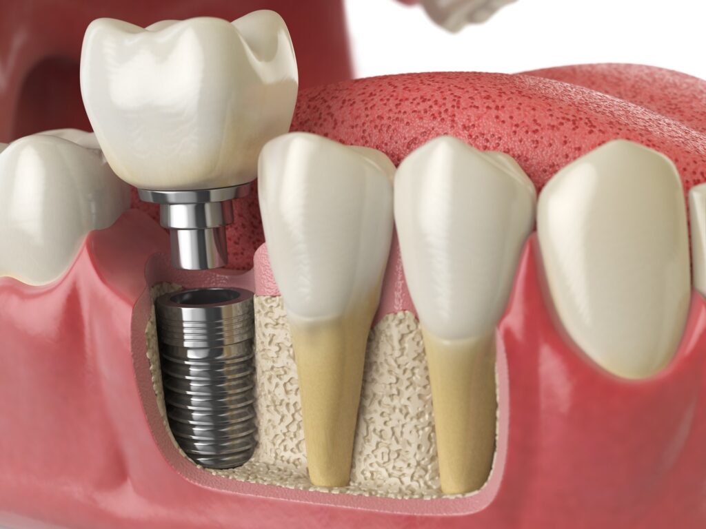 Dental Implants – A Guide