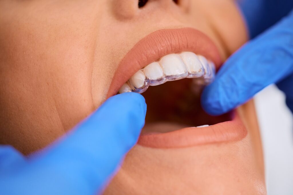 Invisalign Clear Aligners