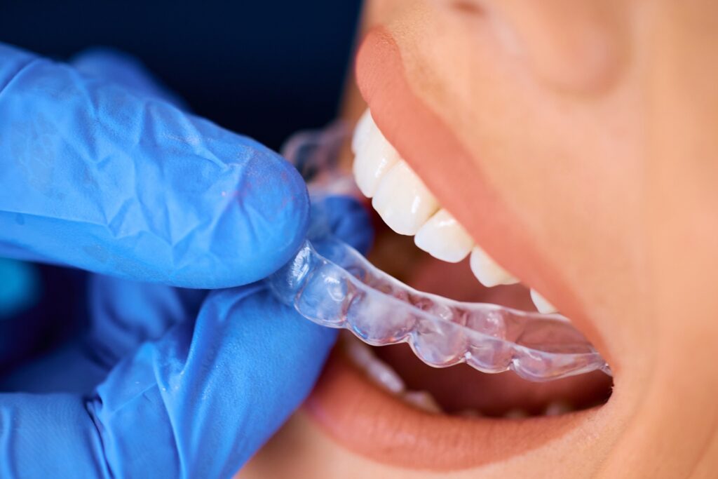 The Invisalign Process: What to Expect