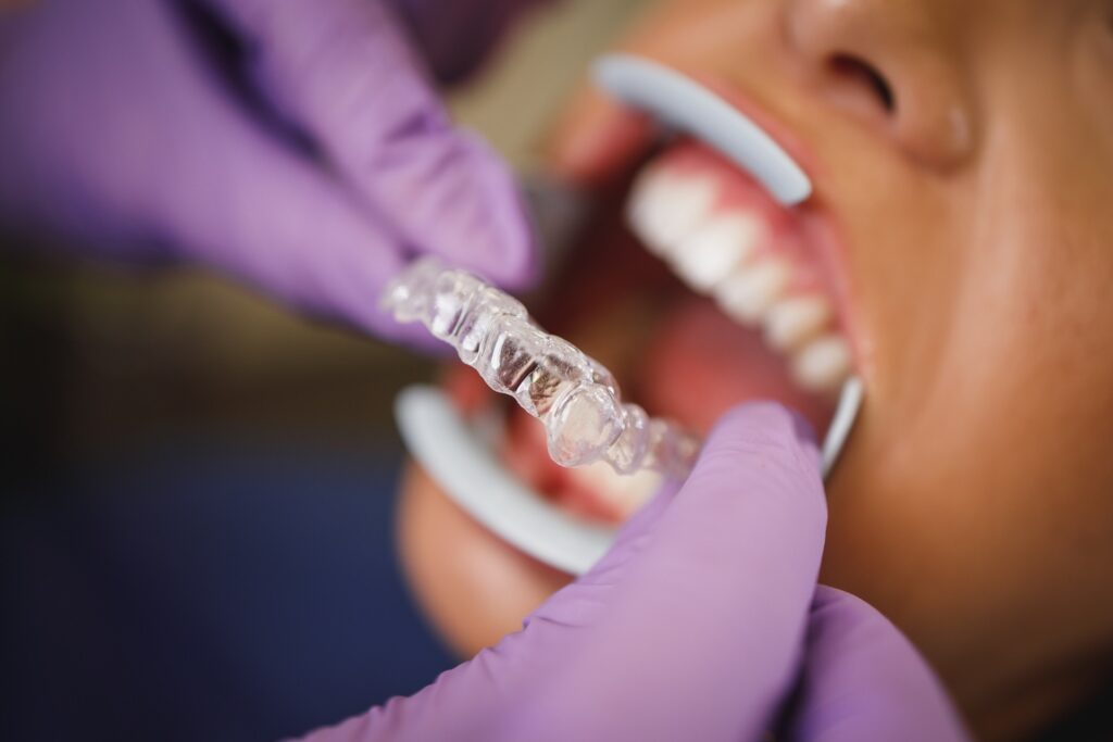 Everything to Expect During Your Invisalign Treatment