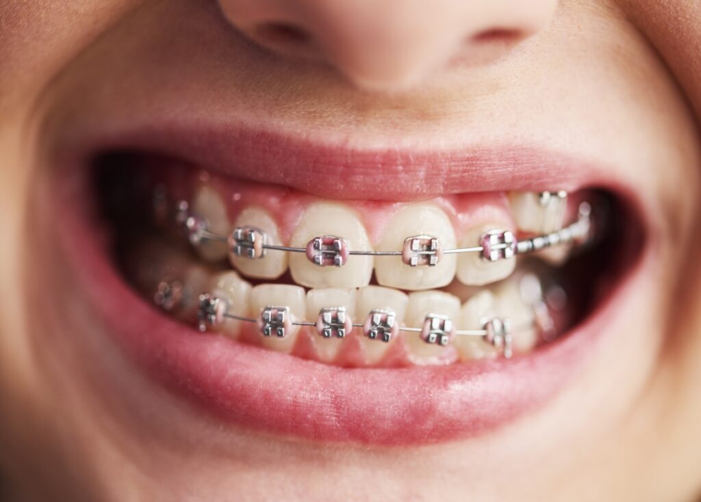 Invisalign vs. Traditional Braces