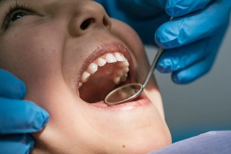 Avoiding Common Issues with Composite Bonding