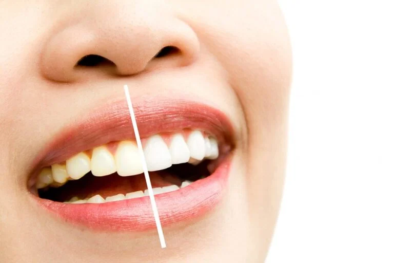 Composite Bonding Brighten Discoloured Teeth Effectively