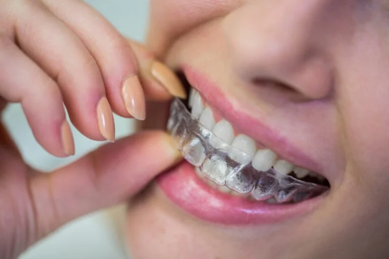 Dealing with Invisalign Attachments Falling Off