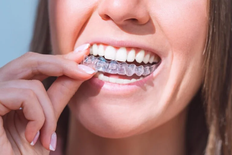 How to Get the Most Out of Your Invisalign Treatment