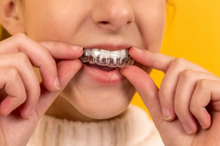 Why People Choose Invisalign in Merley for Discreet Fixes